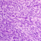   synovialsarcoma
