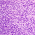 synovialsarcoma
