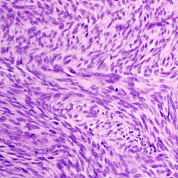 synovialsarcoma