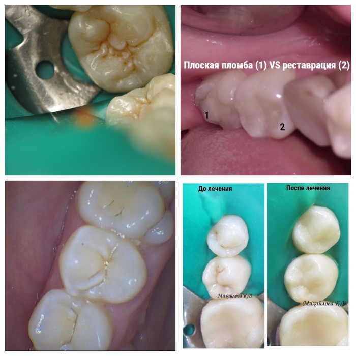 Критерии эффективности лечения зубов thumbnail