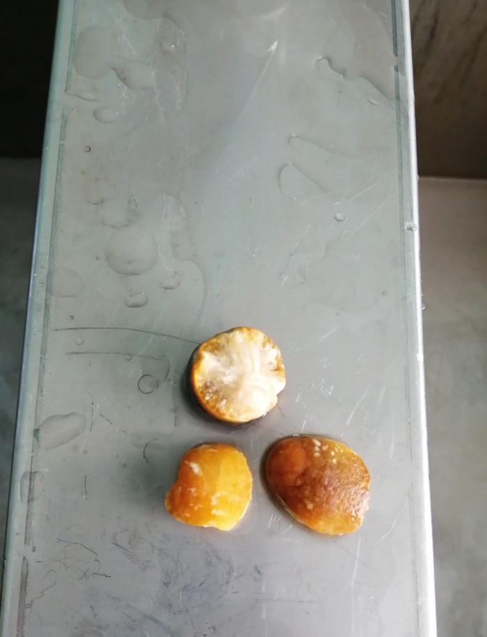 Камни желчного пузыря