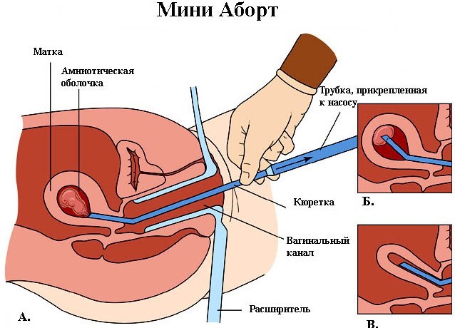 Как Делают Аборты Фото