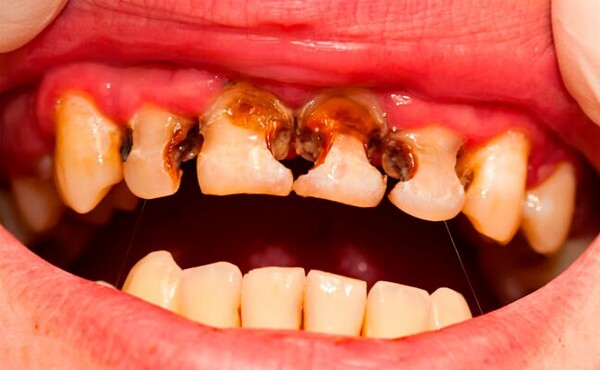 Почему крошатся зубы: причины, диагностика, что делать.