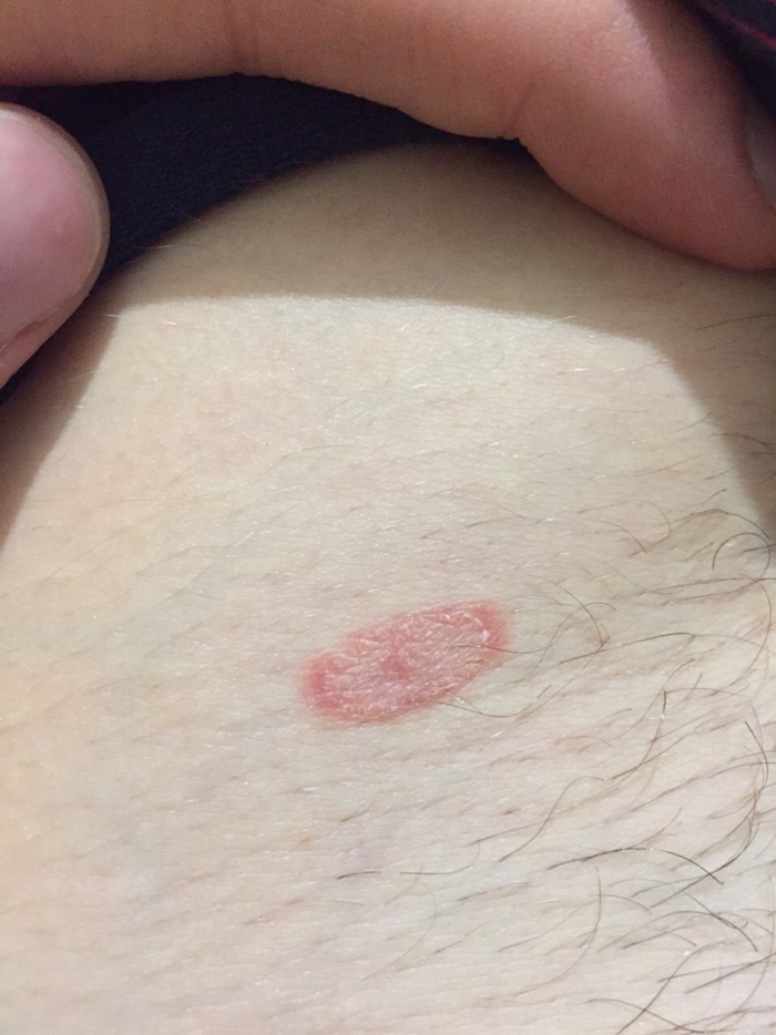 Нашел у себя вот такое пятно и оно меня немного беспокоит. Хочется узнать что это может быть