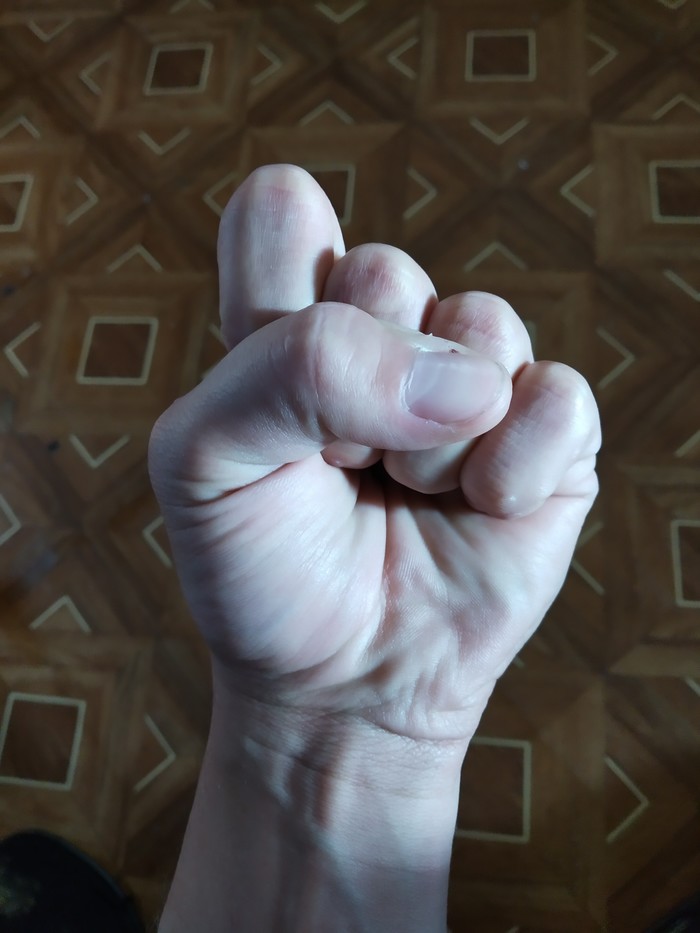 Èñòîðèÿ îäíîãî ïåðåëîìà (îòêðûòîãî) Ïåðåëîì, Âðà÷è, Áîëãàðêà, Ìàò, ×åðíûé þìîð, Îò÷åò, Äëèííîïîñò, Æåñòü