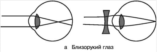 У близоруких людей изображение фокусируется перед