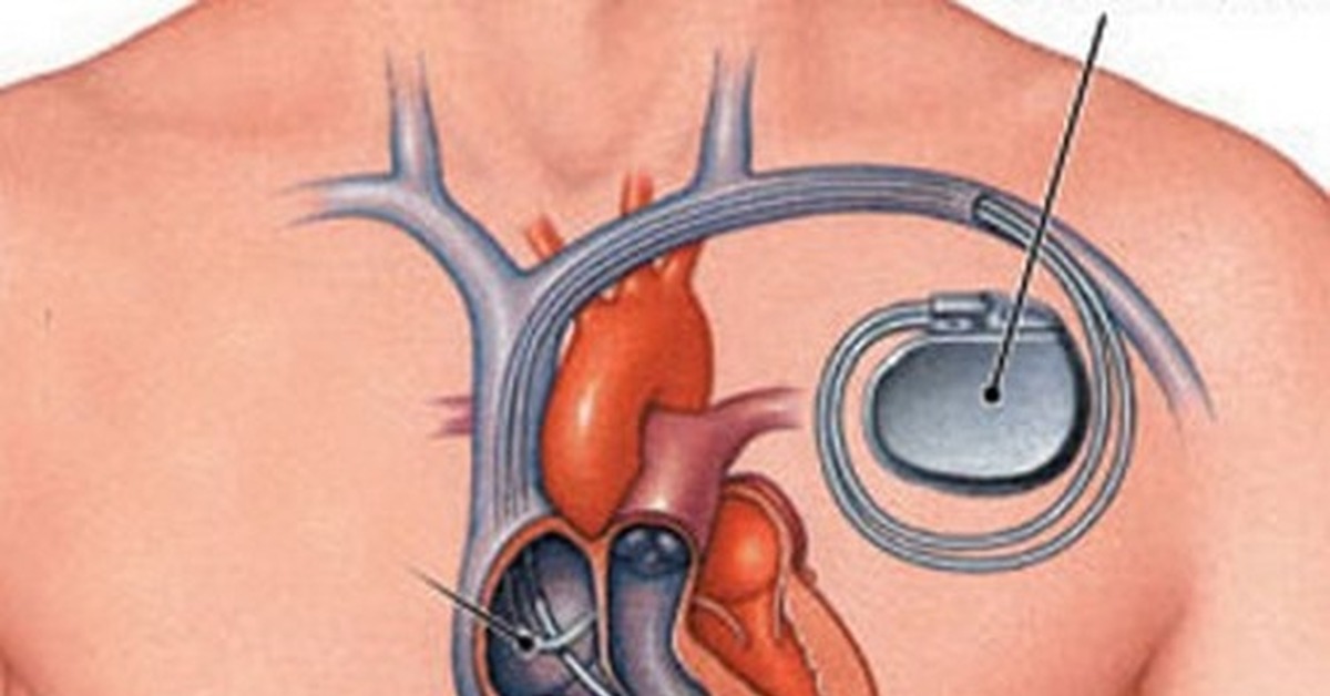 Водитель сердца. Искусственный водитель ритма. Имплантация кардиостимулятора. Электрокардиостимулятор имплантируемый двухкамерный.