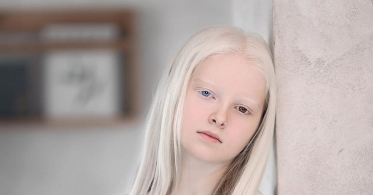 Почему у альбиносов косые глаза