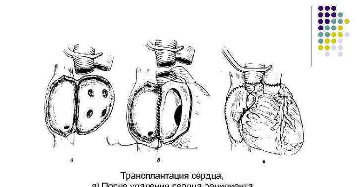 Трансплантация сердца презентация