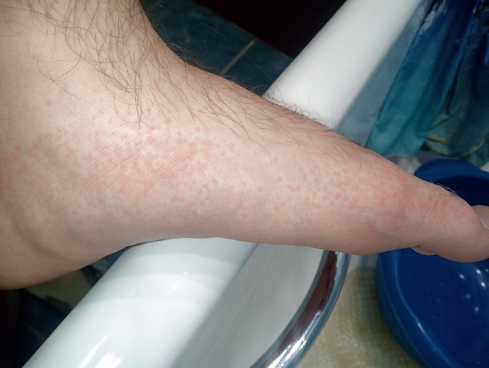 Меня жалят тысячи игл