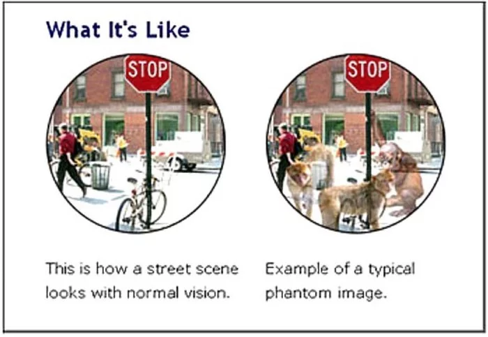 зрительный галлюциноз ван богарта. синдром шарля бонне это. синдром галлюцинации. зрительный галлюциноз шарля бонне. синдром шарля бонне это.