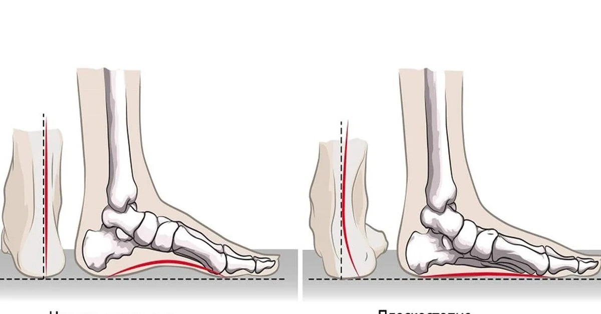 Нарушения стопы. Кости стопы плоскостопие. Плоскостопие вид сбоку. Плоскостопие это уплощение сводов стопы. Плоскостопие анатомия стопы.