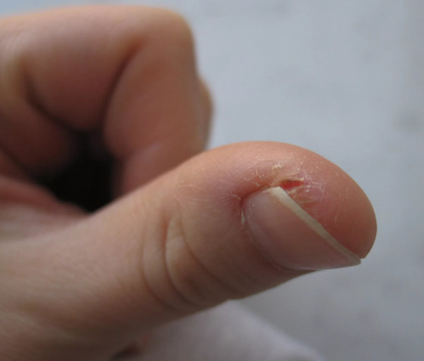 Облазит кожа на пальцах рук: причины шелушения и методы лечения - Fitomarket