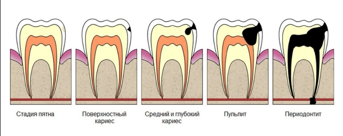 Кариес Жевательных Зубов Фото