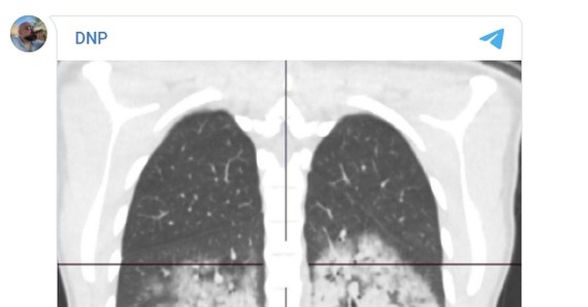 20 легких. Лёгкие вейпера рентген. Рентген лёгких курильщика вейпа. Рентген при курении вейпа. Кт легких при курении вейпа.