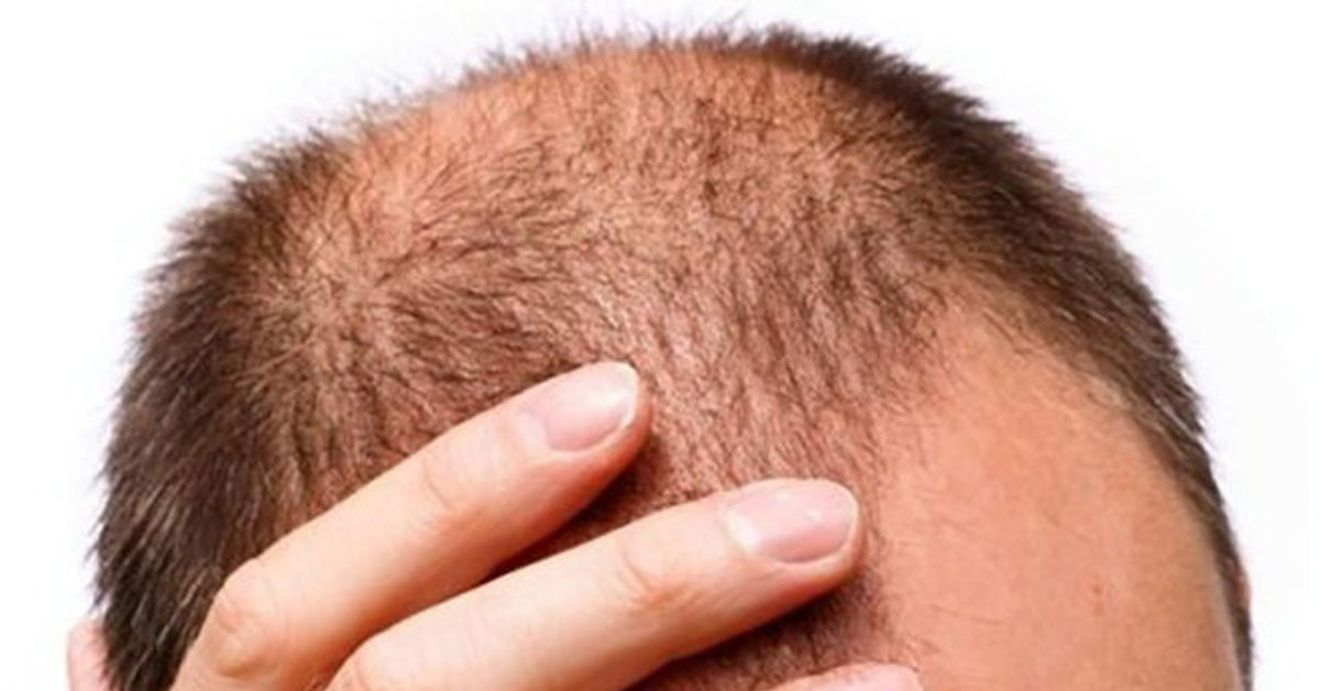 На ногах выпадают волосы причины. Male pattern baldness. Облысение из за стресса.