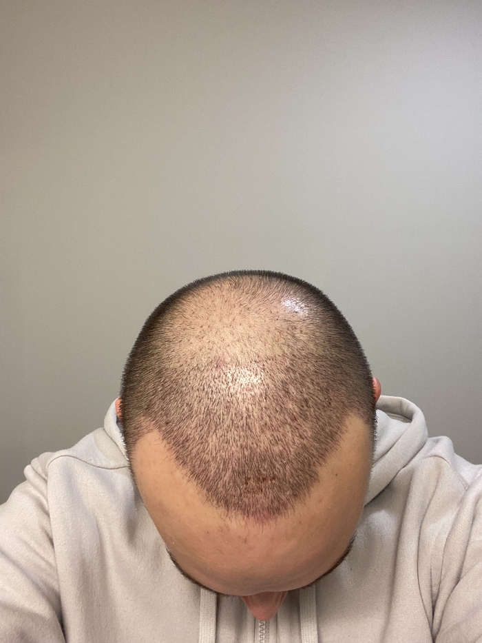 Пересадка волос в Турции Волосы, Пересадка волос, Турция, Длиннопост