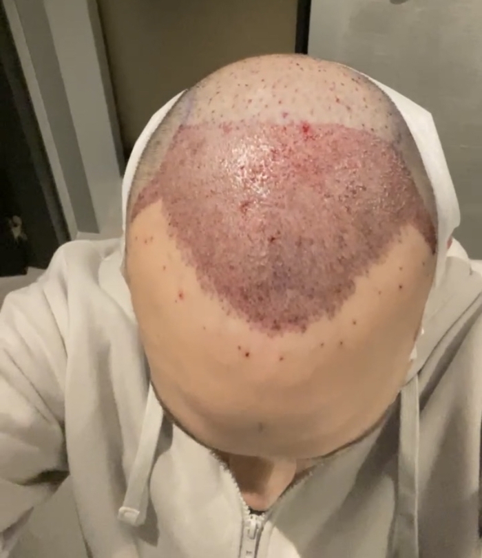 Пересадка волос в Турции Волосы, Пересадка волос, Турция, Длиннопост