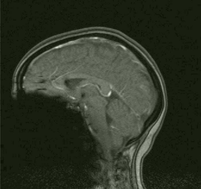 Мрт головного мозга. Как думаете, что с пациентом?