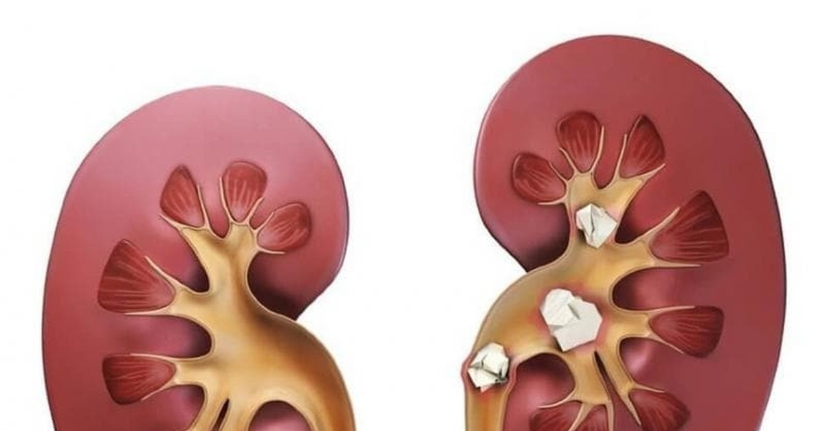 Типы камней в почках классификация. Камни в почках стол. Диетическое меню при заболевании почек. Камни в почках стол. Камни в почках стол.