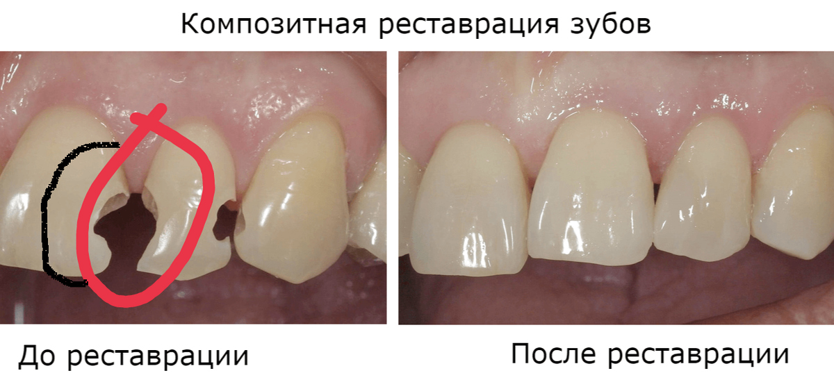 Восстановление должно быть. Восстановление фронтальных зубов. Наращивание зубов композитными материалами.