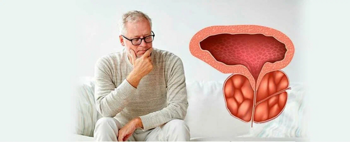 Простатит, аденома простаты и рак простаты. Что должен знать абсолютно каждый мужчина?