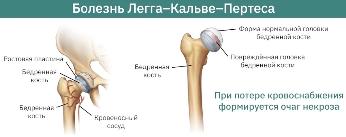 Болезнь пертеса. Болезнь Легга Кальве Пертеса. Легга Кальве Пертеса у собак.