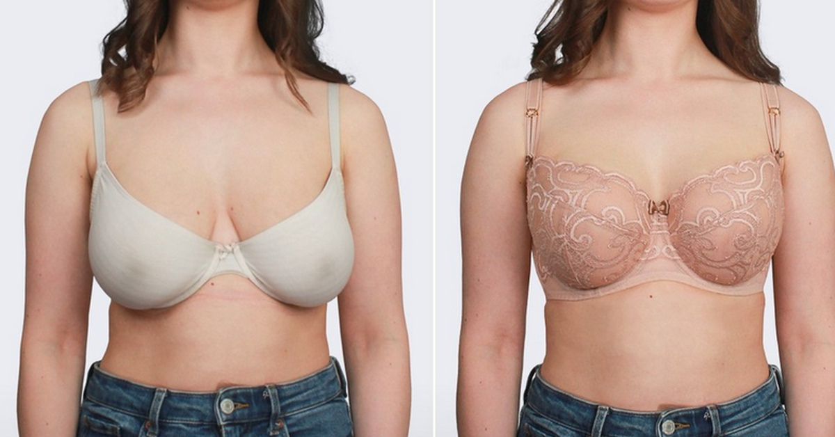 Асимметрия груди в спб | Цены, фото до после, отзывы