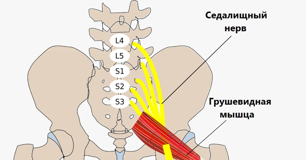 Блокада при защемлении седалищного. Блокада седалищного нерва. Снять нагрузку с грушевидной мышцы. Как проходит седалищная мышца. Грушевидная мышца зажала седалищный нерв симптомы лечение.