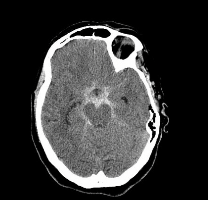 Ответ на пост «Как выглядит мозг после геморрагического инсульта» | Пикабу