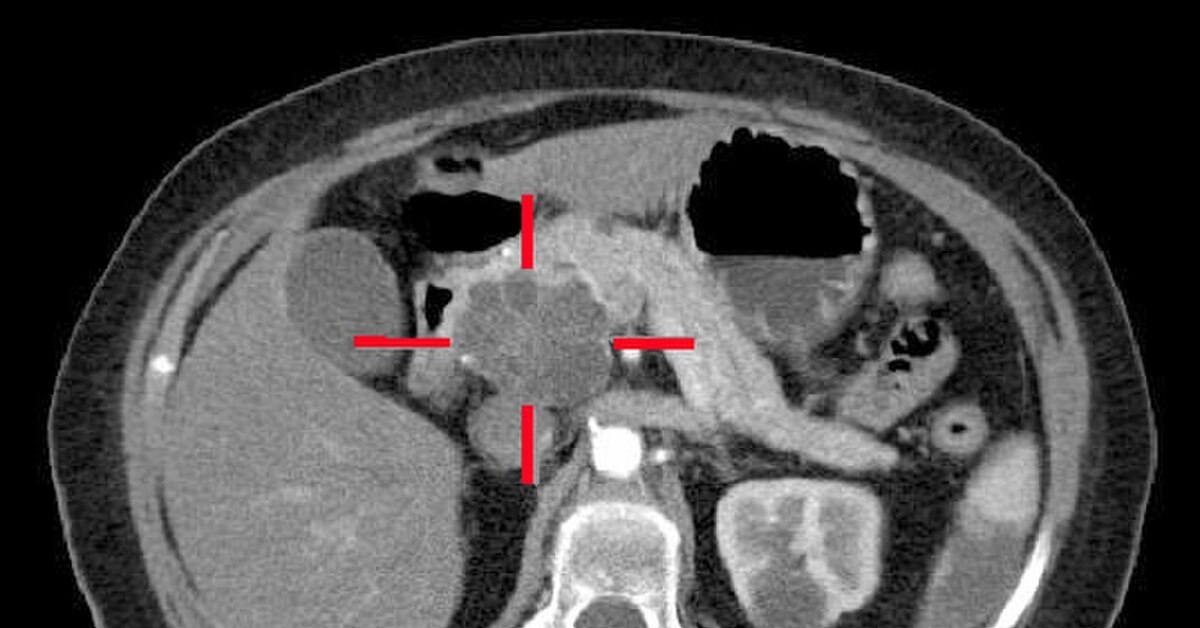 Кт признаки поджелудочной железы
