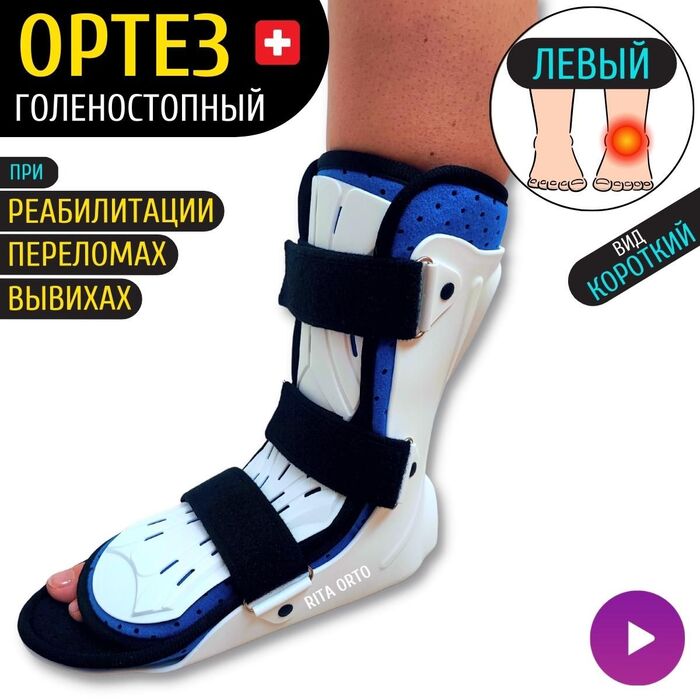 Перелом плюсневых костей. Отёк и посинение ноги. Операция? Ортез вместо ...