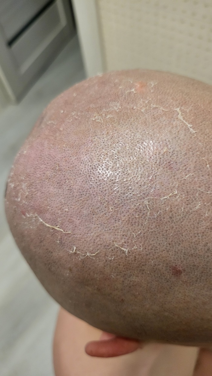 Ахтунг! Лысина в опасносте!