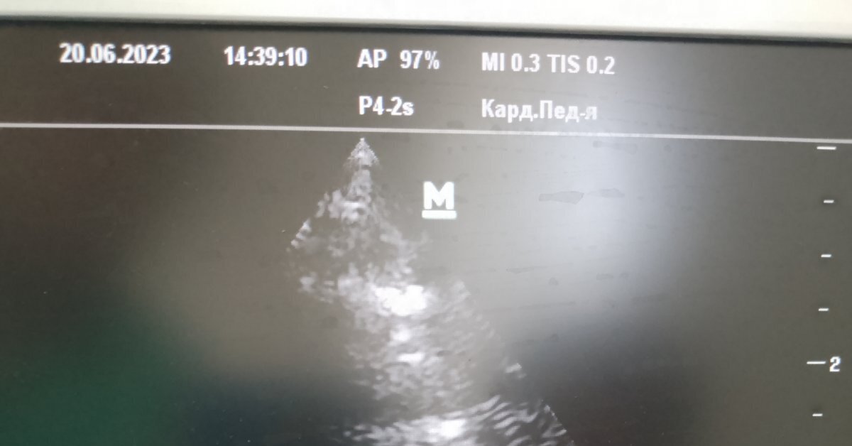 Результаты УЗИ сердца | Пикабу