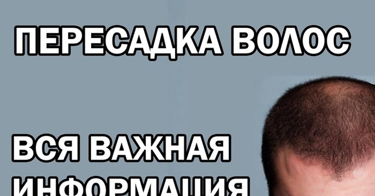 Пересадка волос: что нужно знать | Пикабу