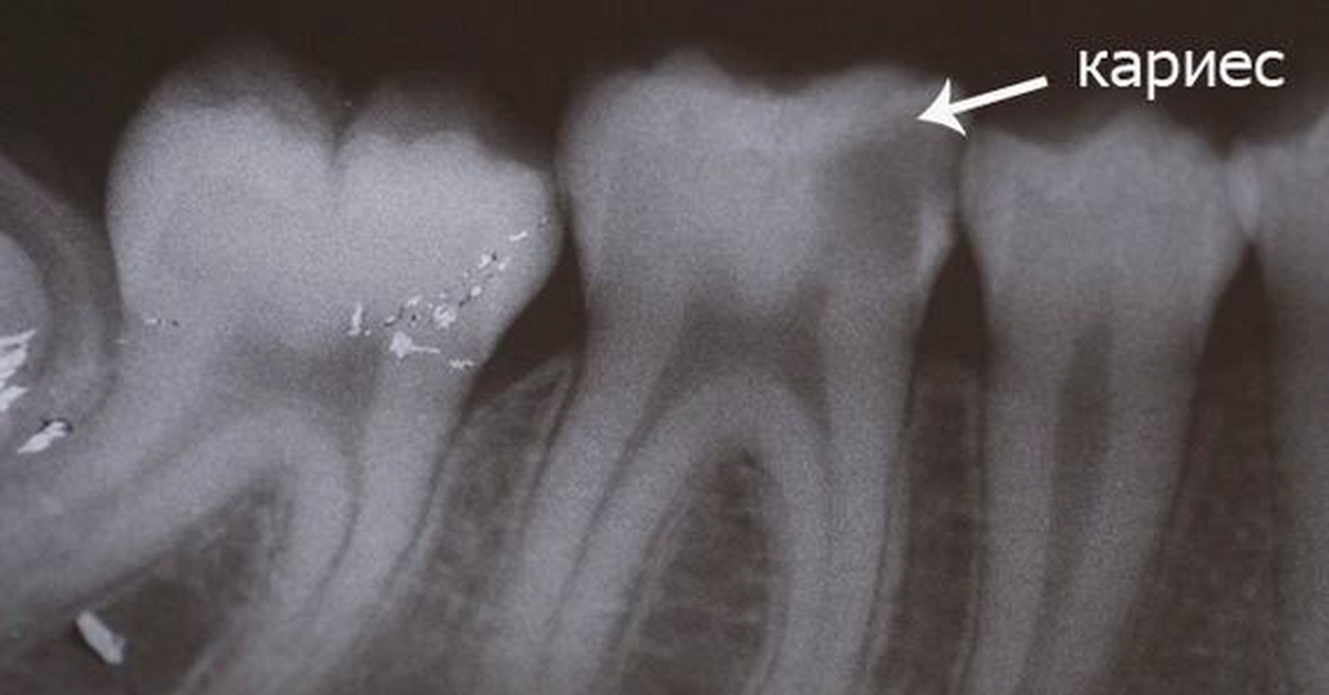 Кариес на снимке. Кариес под пломбой рентген зуба. Пульпит рентген под пломбой. Кариес под пломбой на рентгенограмме.
