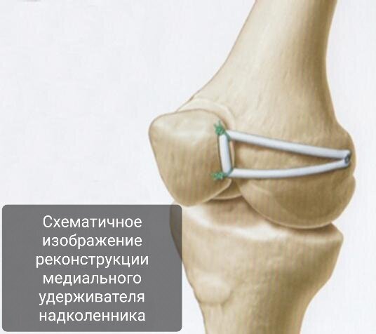 Вывих надколенника. Часть 3. Хирургические методы лечения | Пикабу