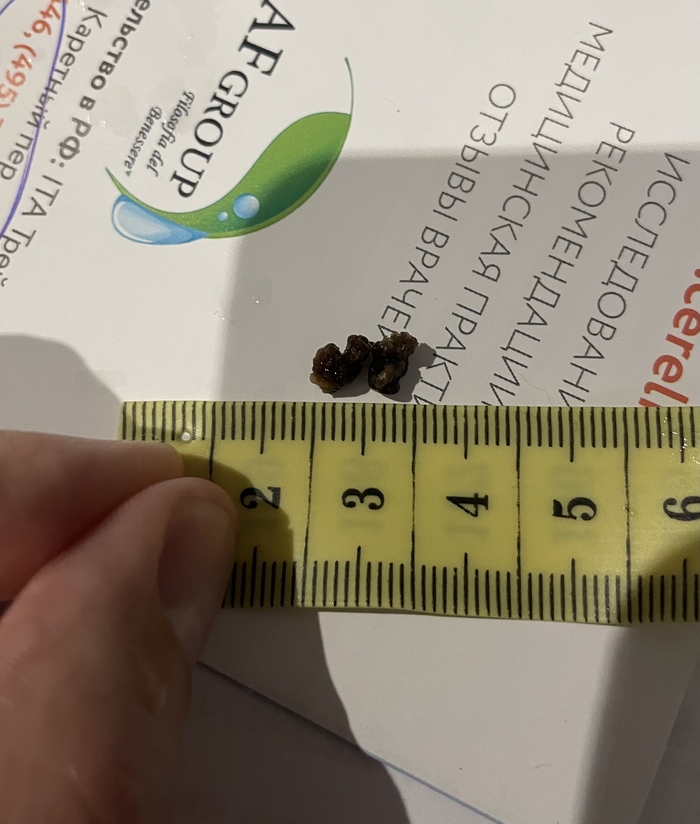 Вот такие два почечных камня только что вышли из моего пениса. Каждый по 5мм. Не болейте ребята