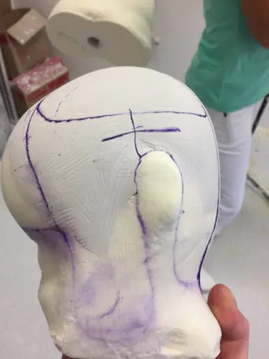 Первый ортопедический шлем в России для детей с деформацией головы | Пикабу