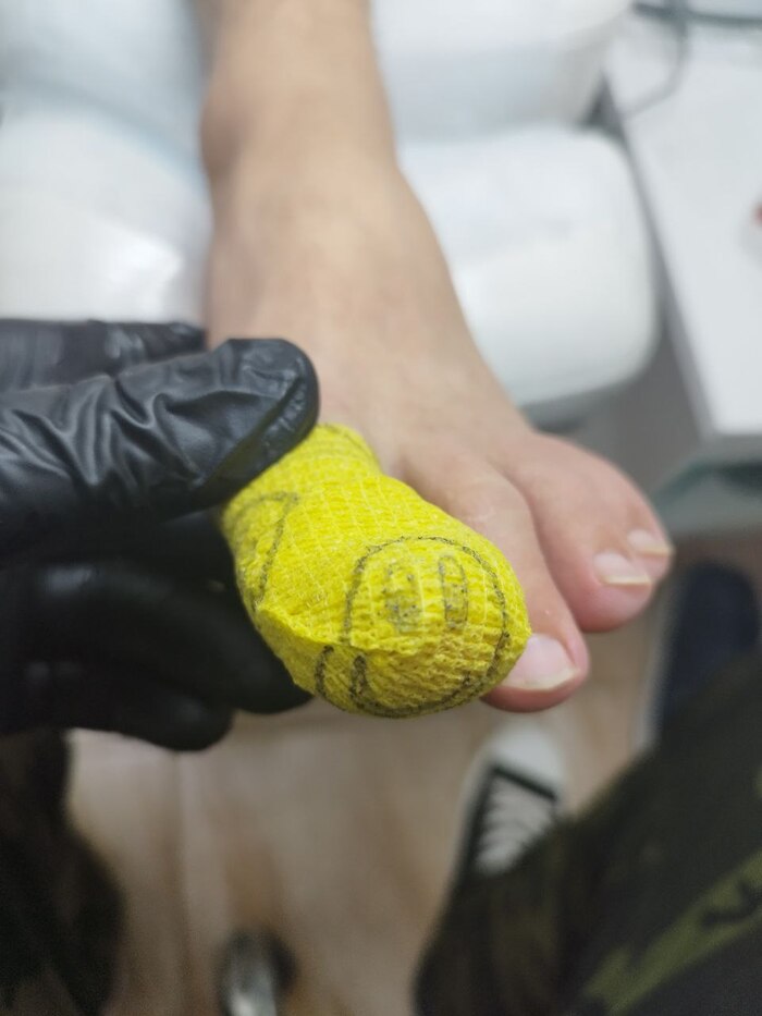 делаю повязку и отправляю домой до завтра, так как нужно опять все промыть, посмотреть и так пару дней и только потом можно ставить титановую нить.