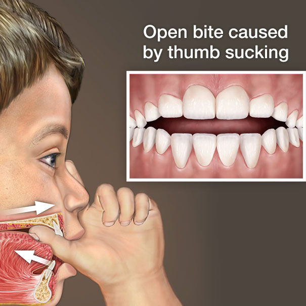 Формирование открытого прикуса при сосании пальца