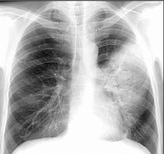Помогите с расшифровкой рентгенограммы