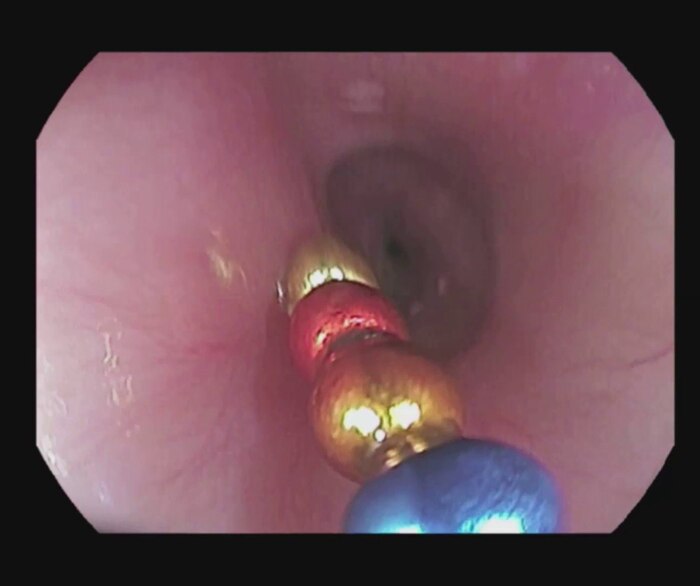 Хирурги достали из кишечника мальчика 16 магнитных шариков