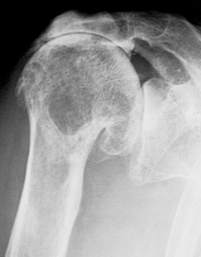 Выраженный артроз плечевого сустава.