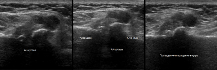 Поражение АКС на УЗИ.