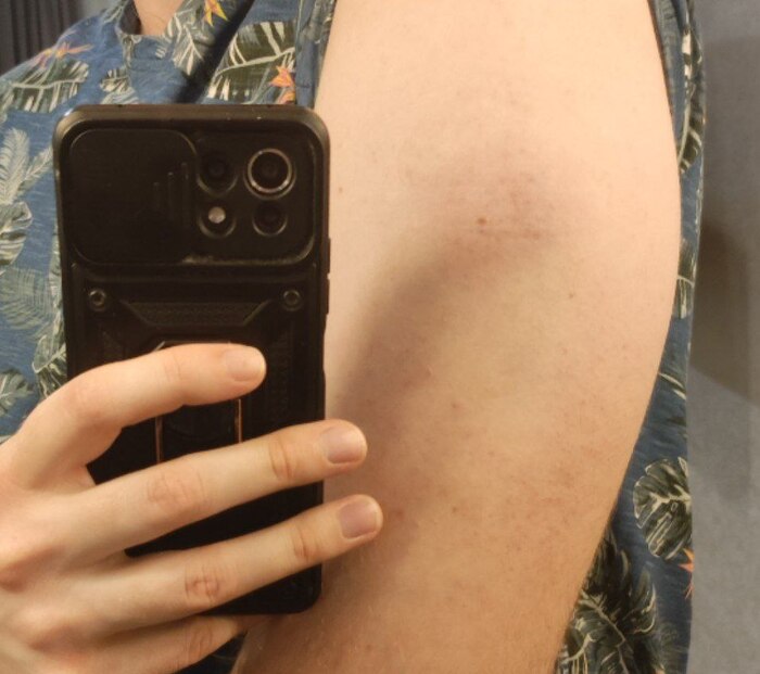 на уровне камер синяк был диаметром до 3х см. Жив, волосы не выпали