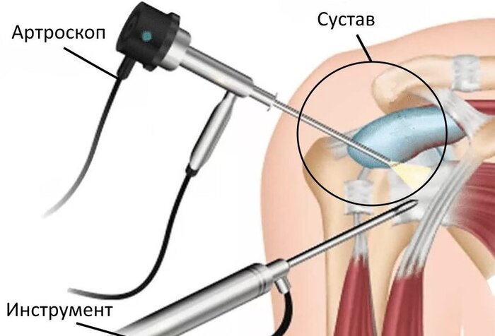 Принцип артоскопии плечевого сустава.