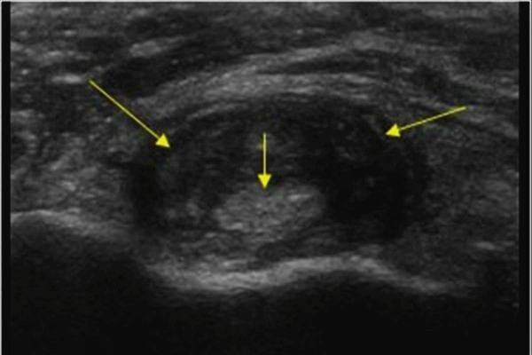Выраженный отек (темная зона) вокруг длинной головки бицепса (серый в центре).