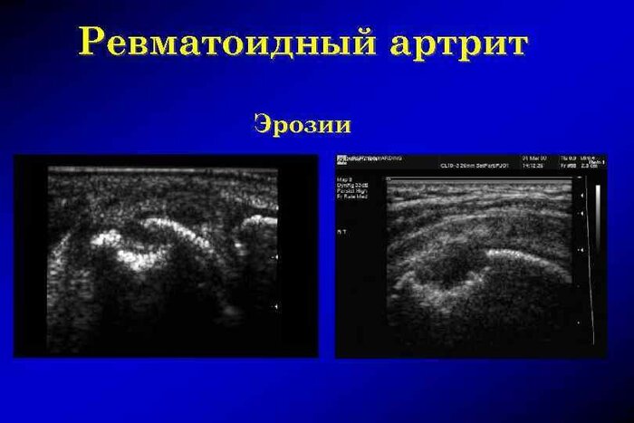 Дефект кортикального слоя кости - одно из рентгенологических проявлений ревматоидного артрита.