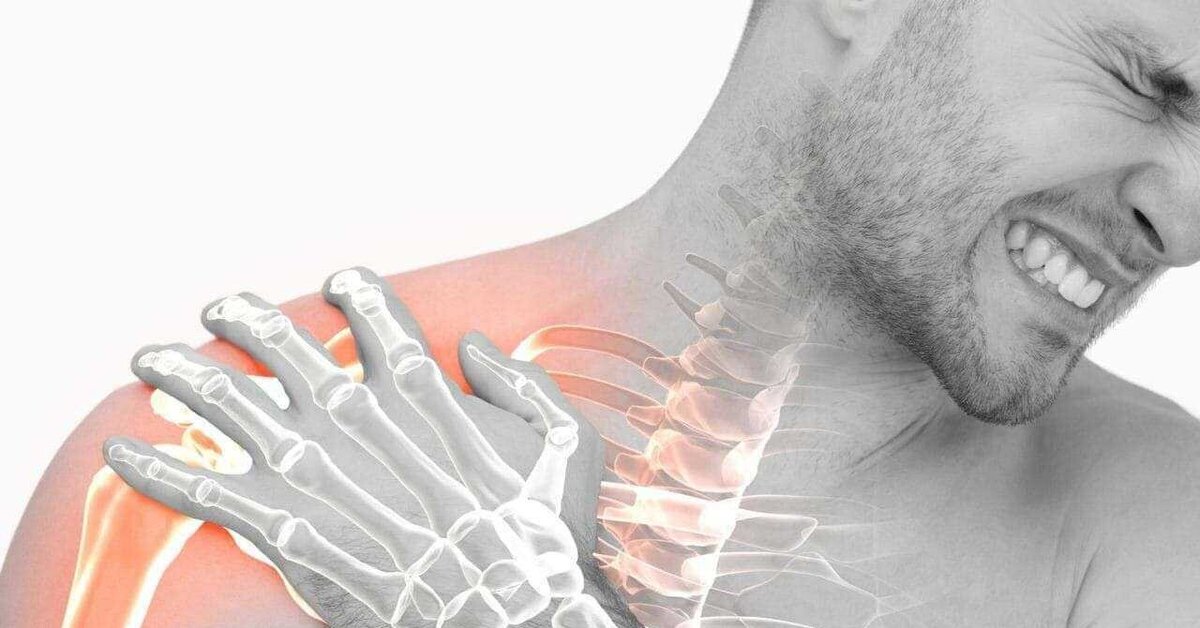 Сильные боли после травмы. Туннельный синдром плечевого сустава. Плексит плечевой плексит.